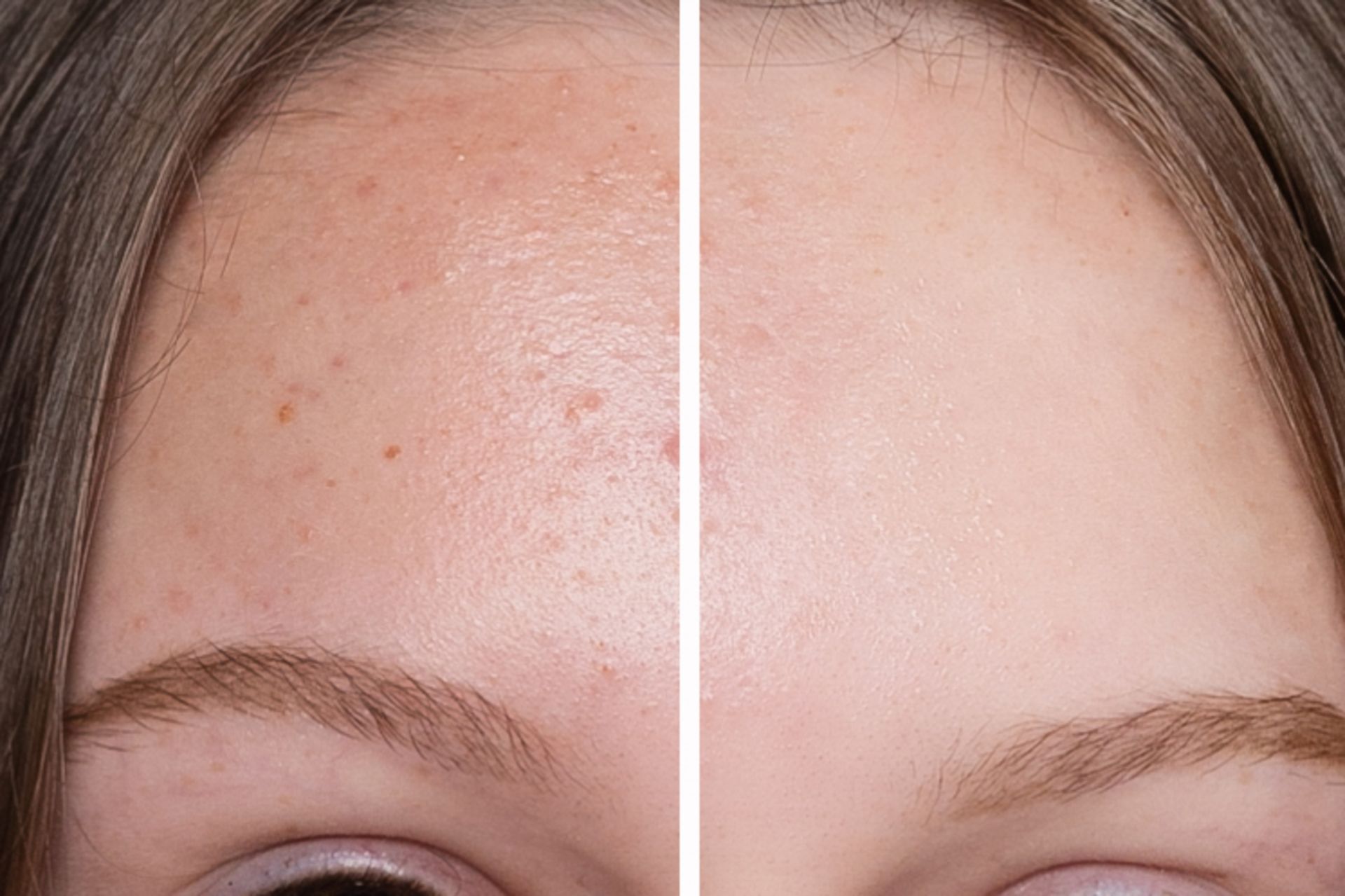 A before and after photo of a woman 's forehead with acne and without acne.