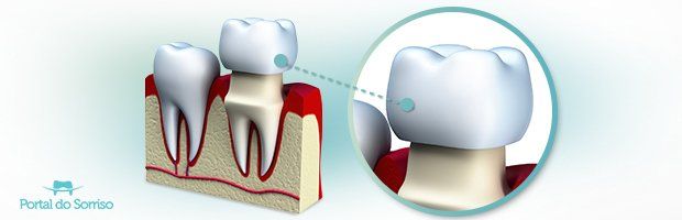 O Que E Uma Coroa Dentaria
