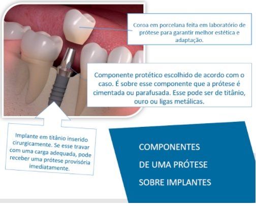 Componentes de um implante dentário