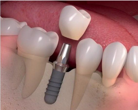 Coroa de um implante dentário