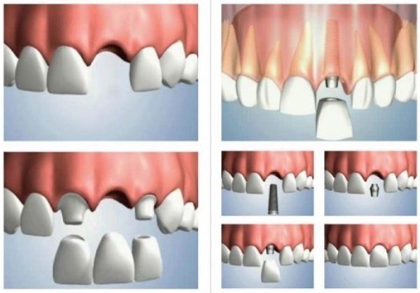 Implante dentário diferenças