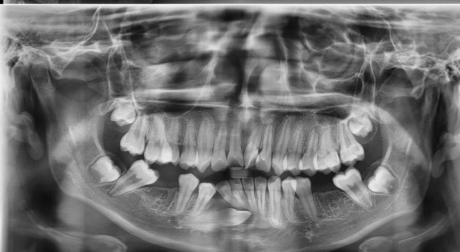 DIAGNÓSTICO RADIODENTAL URUAPAN - AP