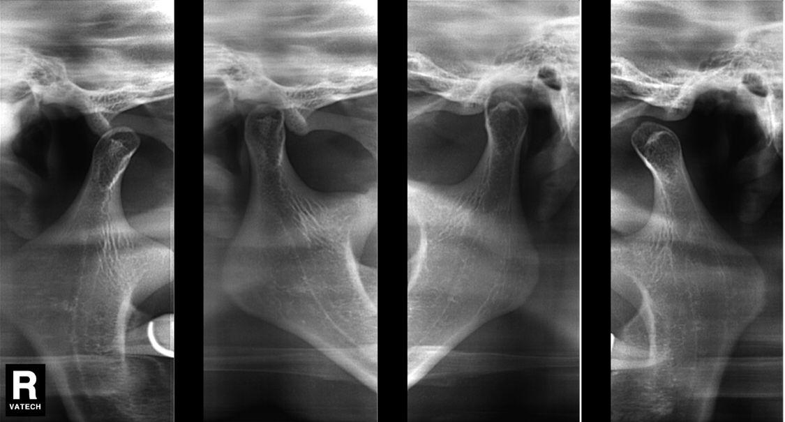 DIAGNÓSTICO RADIODENTAL URUAPAN - PANORAMICA DENTAL