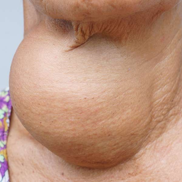 goiter, close-up view. Skin appears aged, with folds and wrinkles.