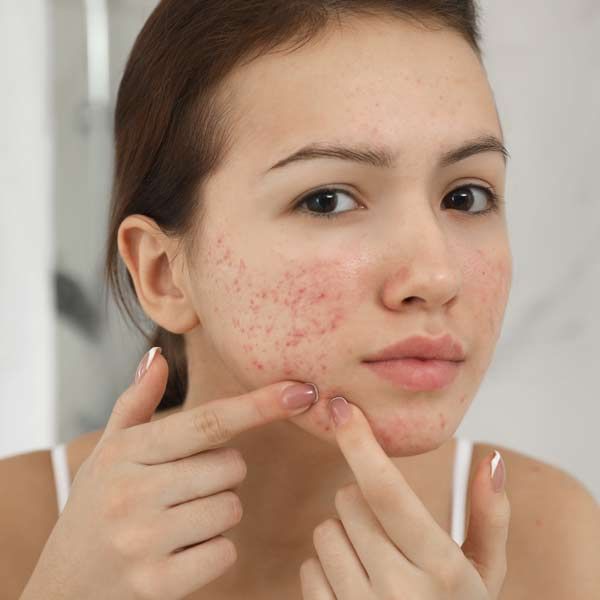 A woman with acne on her face is looking at her face in the mirror for Acne Treatments
