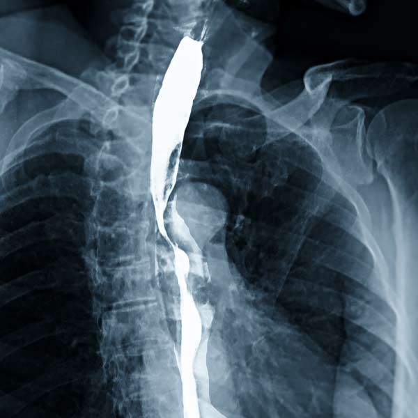 A close-up of an X-ray of a person's chest and esophagus needing Barrett's Esophagus Treatments