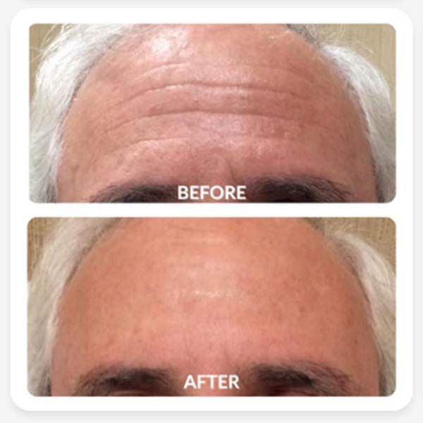 Forehead with horizontal wrinkles before and after treatment, appearing smoother in