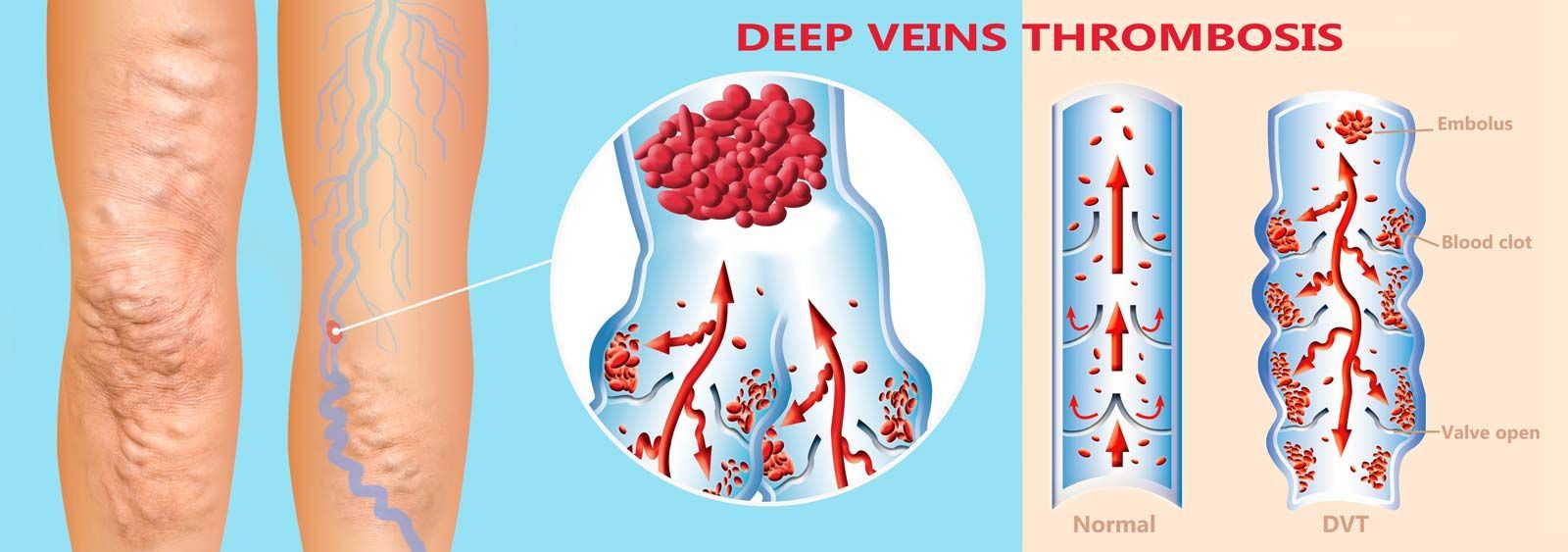 Diagram of legs with varicose veins, and illustration of deep vein thrombosis showing blood clots in veins.
