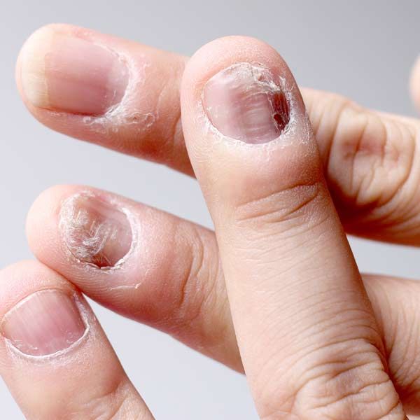 Fingers with nail and skin fungus needing Candidiasis Infections Integrative and Functional Medical Treatments by Salerno Wellness in Manhattan, NY, and Connecticut