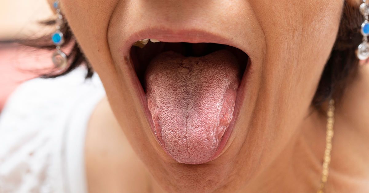 A woman who needs Candida Treatments NYC based on her open mouth showing oral thrush.