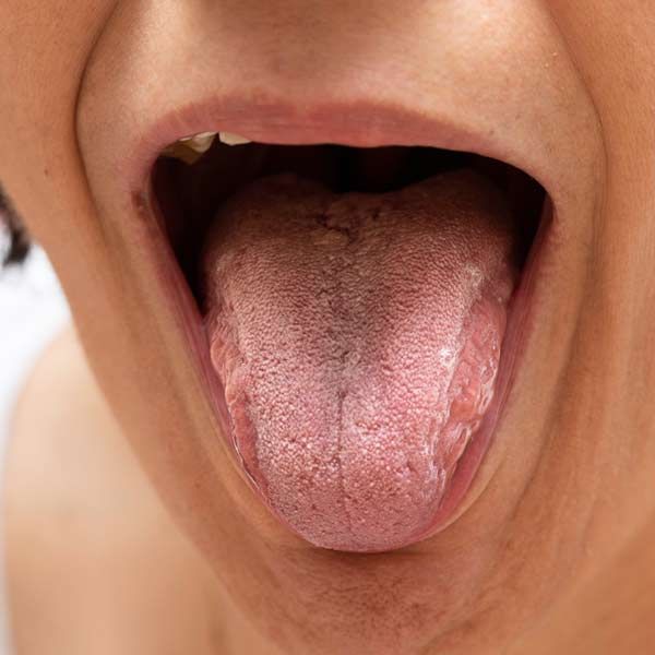 Close-up of a person's open mouth with oral thrush needing Candida Treatments.