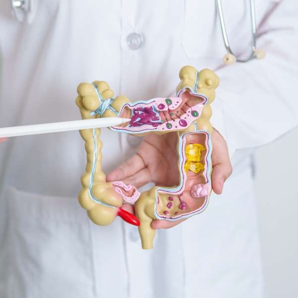 A doctor pointing to bulging pouches on the intestine model, showing a need for Diverticulitis Treatments