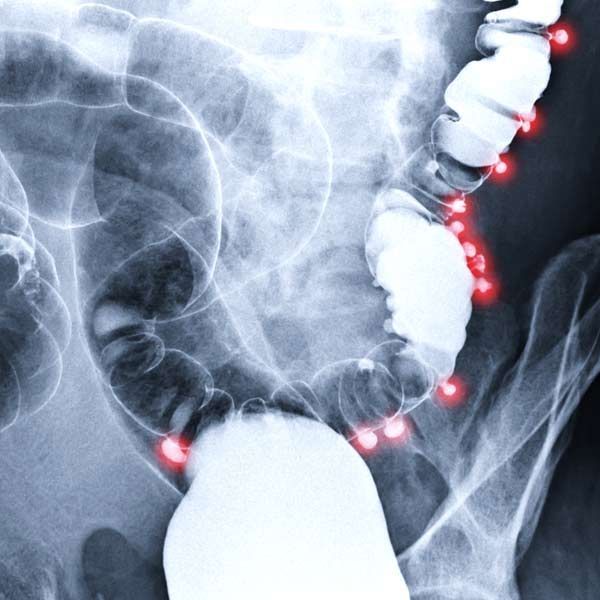 An X-ray of a large intestine with red lights on it showing the need for Medical Non-Surgical Diverticulitis Therapy by Salerno Wellness in Manhattan, NY, and Connecticut