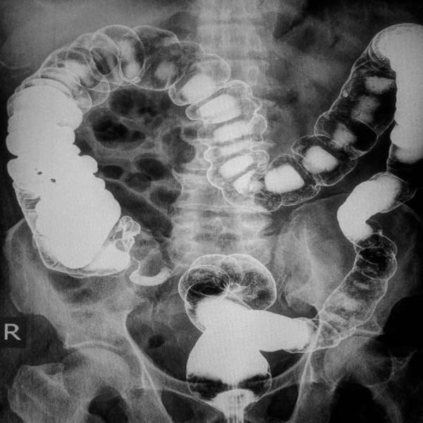 Barium enema showing small diverticulosis in transverse colon. A black and white x-ray of colon showing need for Functional and Integrative Diverticulosis Therapy That Address The Cause of Patient Symptoms by Salerno Wellness in Manhattan, NY and Connecticut