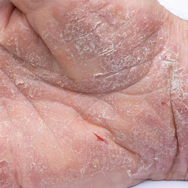 Eczema Treatments are needed for a man with eczema on it
