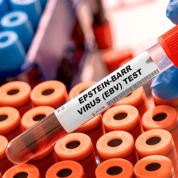A test tube labeled Epstein-Barr virus ( ebv ) test representing Epstein-Barr Treatments