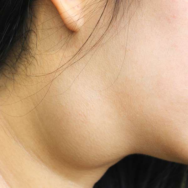 A close up of a woman 's neck and ear needing Goiter Treatments