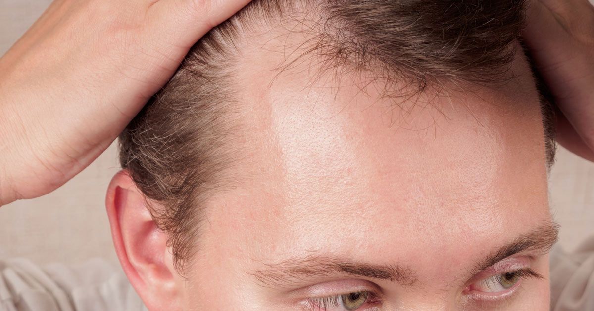 Man with thinning hair, holding head, showing receding hairling participating in Medical Hair Loss Treatments NYC by Dr. John Salerno