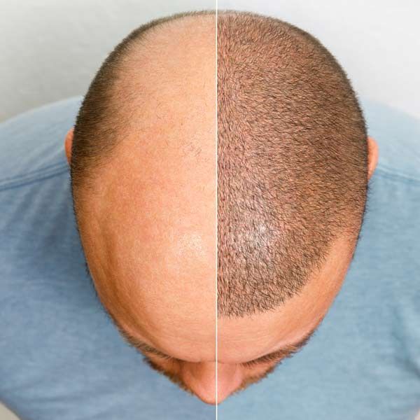 A man 's head is shown before and after a hair growth representing Hair Loss Treatments