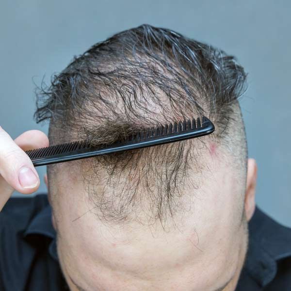 A man 's head is shown before and after a hair growth representing Hair Loss Treatments