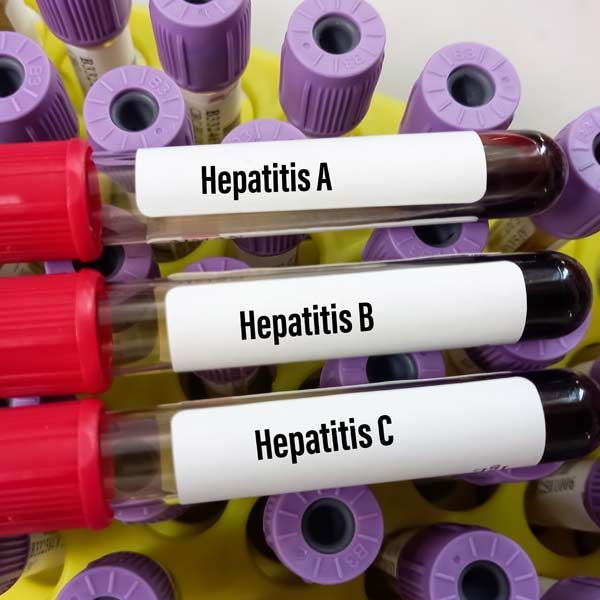 Three test tubes labeled hepatitis A, hepatitis B, and hepatitis C, representing Hepatitis Treatments