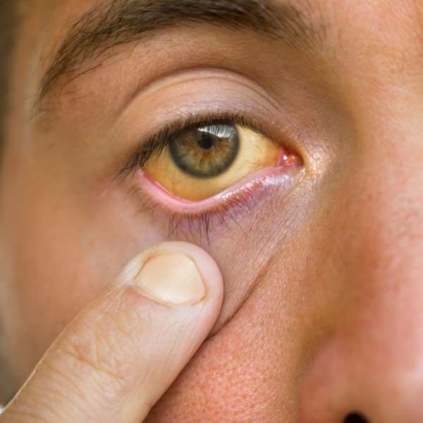 A close-up of a person's eye with a yellowish eye showing a need for Hepatitis and Liver IV Treatments