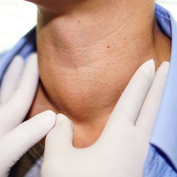 A close-up of a person's neck with a goiter. Comprehensive Integrative and Complementary Medical Care for Hyperthyroidism in Manhattan, NY and Connecticut