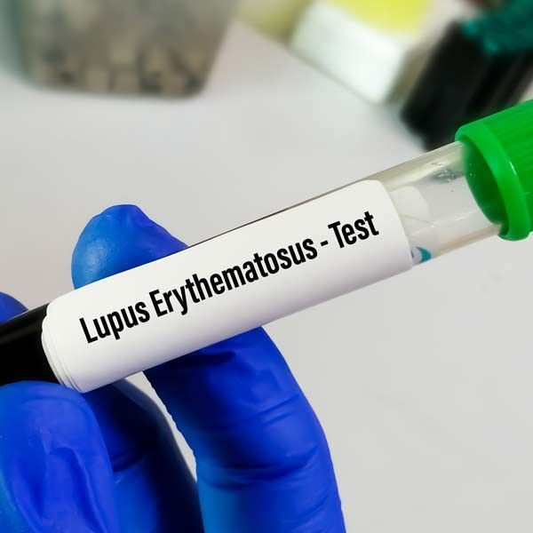 A person wearing blue gloves is holding a test tube for lupus erythematosus representing Lupus Treatments