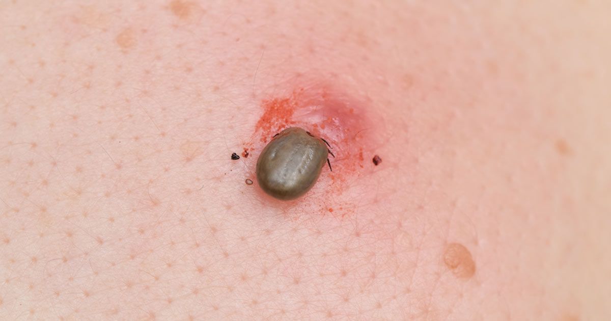 Tick with the Head under the skin. Lyme Disease Survival Tips