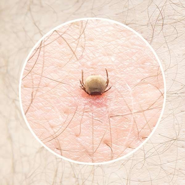 A close up of a tick on a person 's skin representing Lyme Disease Treatments