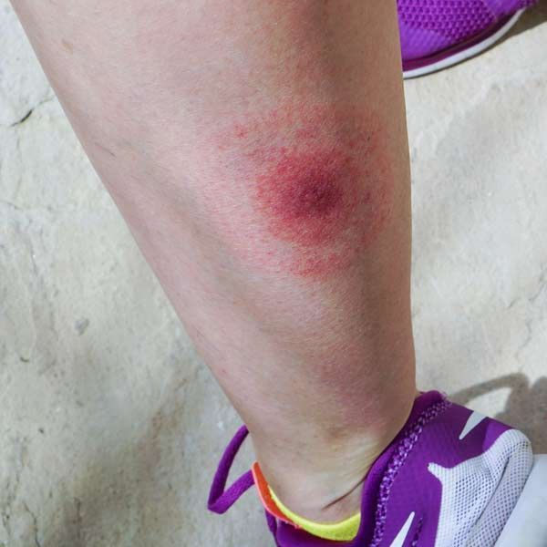 A person wearing purple nike shoes has a rash on their leg indicating Holistic, Integrative, and Complementary Comprehensive Care for Lyme Disease Patients in Manhattan, NY and Connecticut