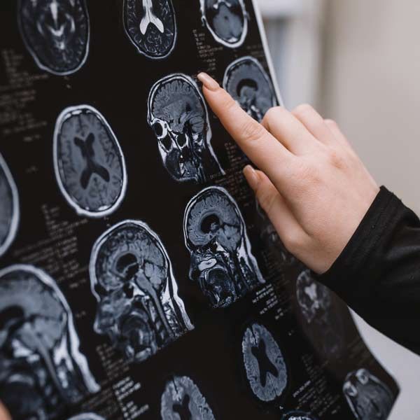 Person's hand pointing at a brain MRI scan, showing cross-sections of the brain during Complementary, Functional, and Integrative Neurodegenerative Condition Therapy by Salerno Wellness in Manhattan, NY, and Connecticut