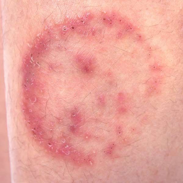 A close-up of a person's leg with a rash from a ringworm parasite infection on it Parasite Infection Cleansing by Salerno Wellness in Manhattan, NY and Connecticut