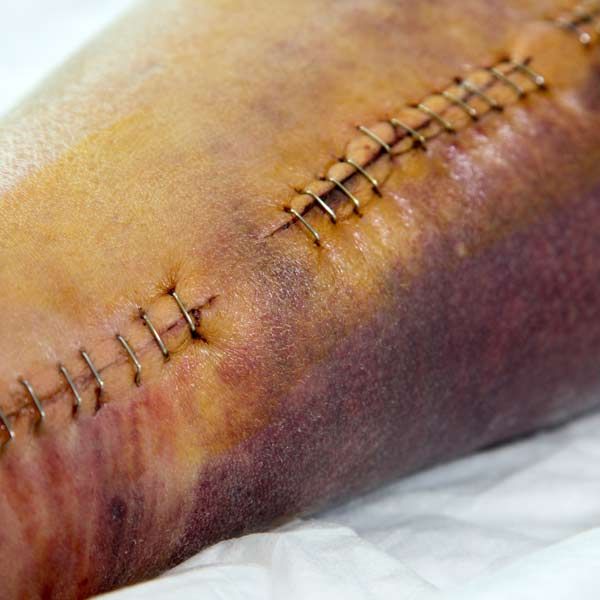 Stitches after surgery represent Post-Surgical Recovery Treatments