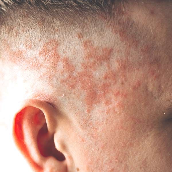 A close up of a person 's face with red spots on it needing Psoriasis Treatments