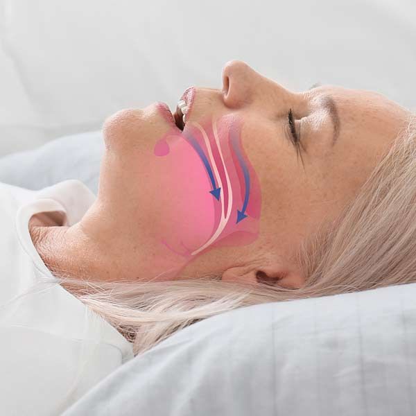 A woman is lying in bed with her mouth open and a diagram of her mouth representing Sleep Apnea Treatments