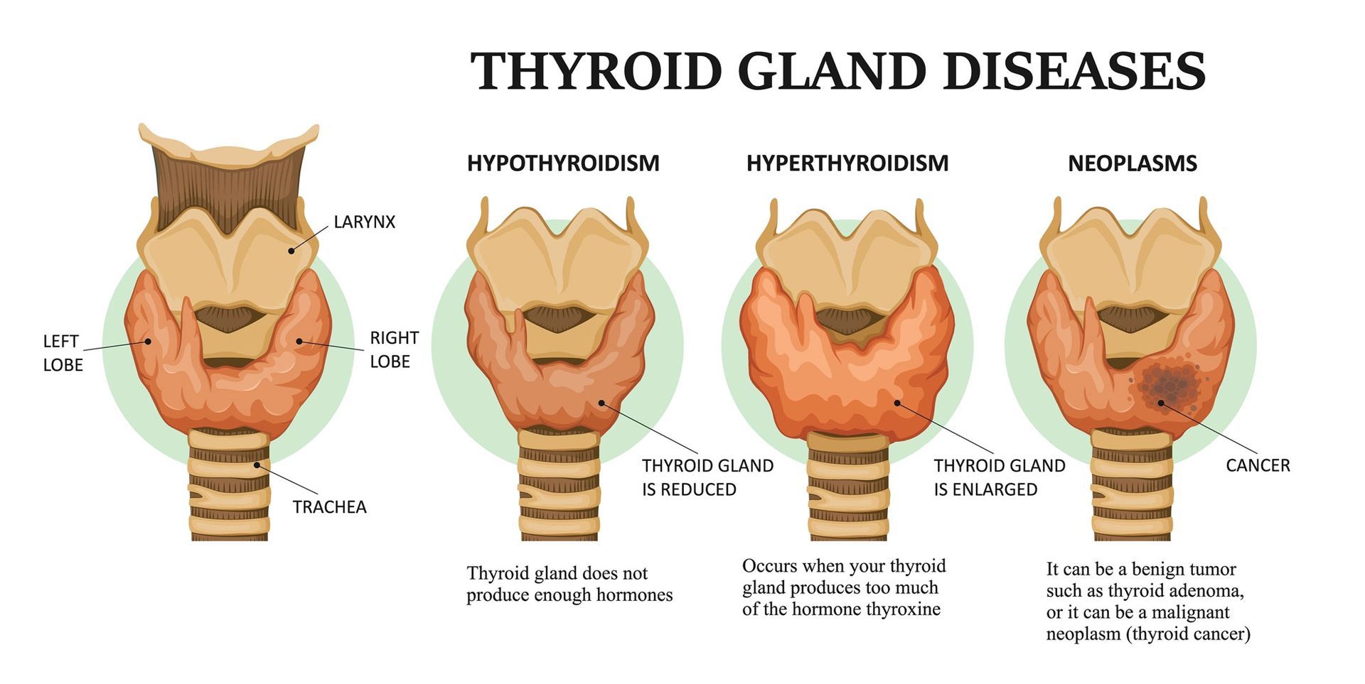 A diagram of different types of thyroid gland diseases.