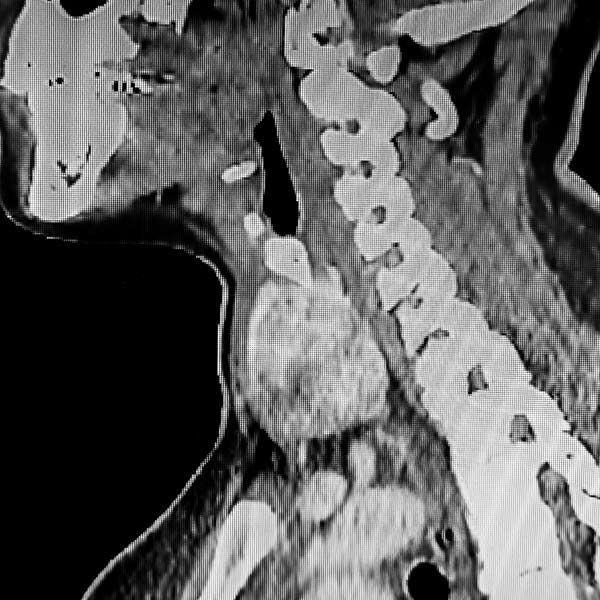 Sonogram of Thyroid Nodules for patient getting Personalized Care for Thyroid Health with Minimally Invasive Procedures by Salerno Wellness in Manhattan, NY, and Connecticut