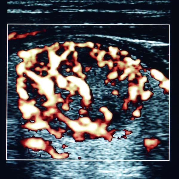 Ultrasound image of thyroid nodules. Ultrasound image of thyroid nodules.
