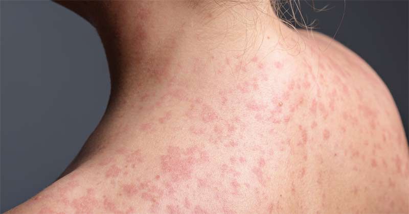 Back of a person with a rash of small, raised, pinkish-red bumps. Vitamin A for Measles and Skin Health