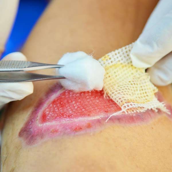 Open would healing representing Wound Healing Treatments