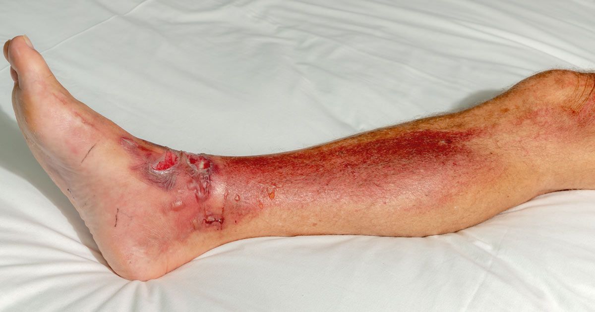 Severe leg injury for Oxygen Wound Healing Treatments NYC by Dr. John Salerno