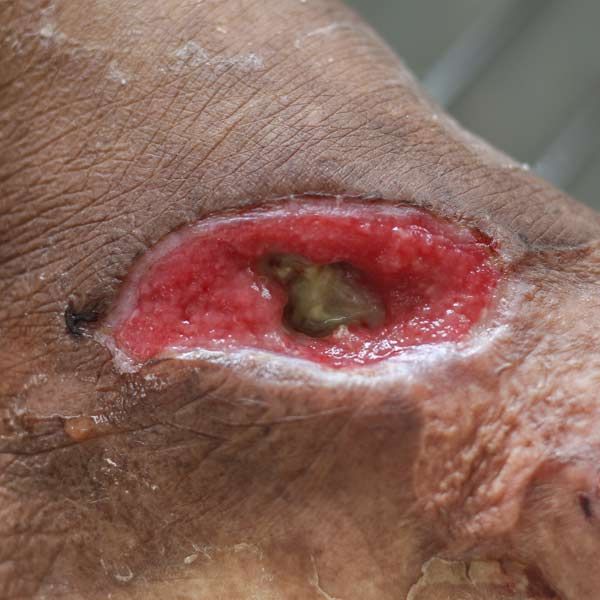 Open Blister for Oxygen Therapy at Salerno Wellness in Manhattan, NY, and Connecticut