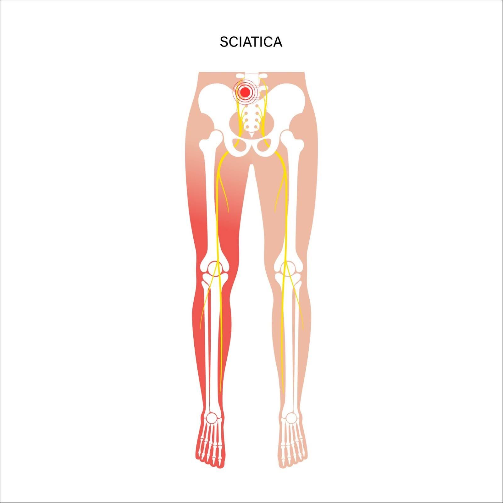 sciatica