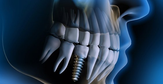 Restorative Dentistry in Pembroke Pines Florida