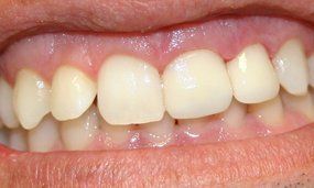 Porcelain Veneers