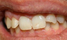 Porcelain Veneers