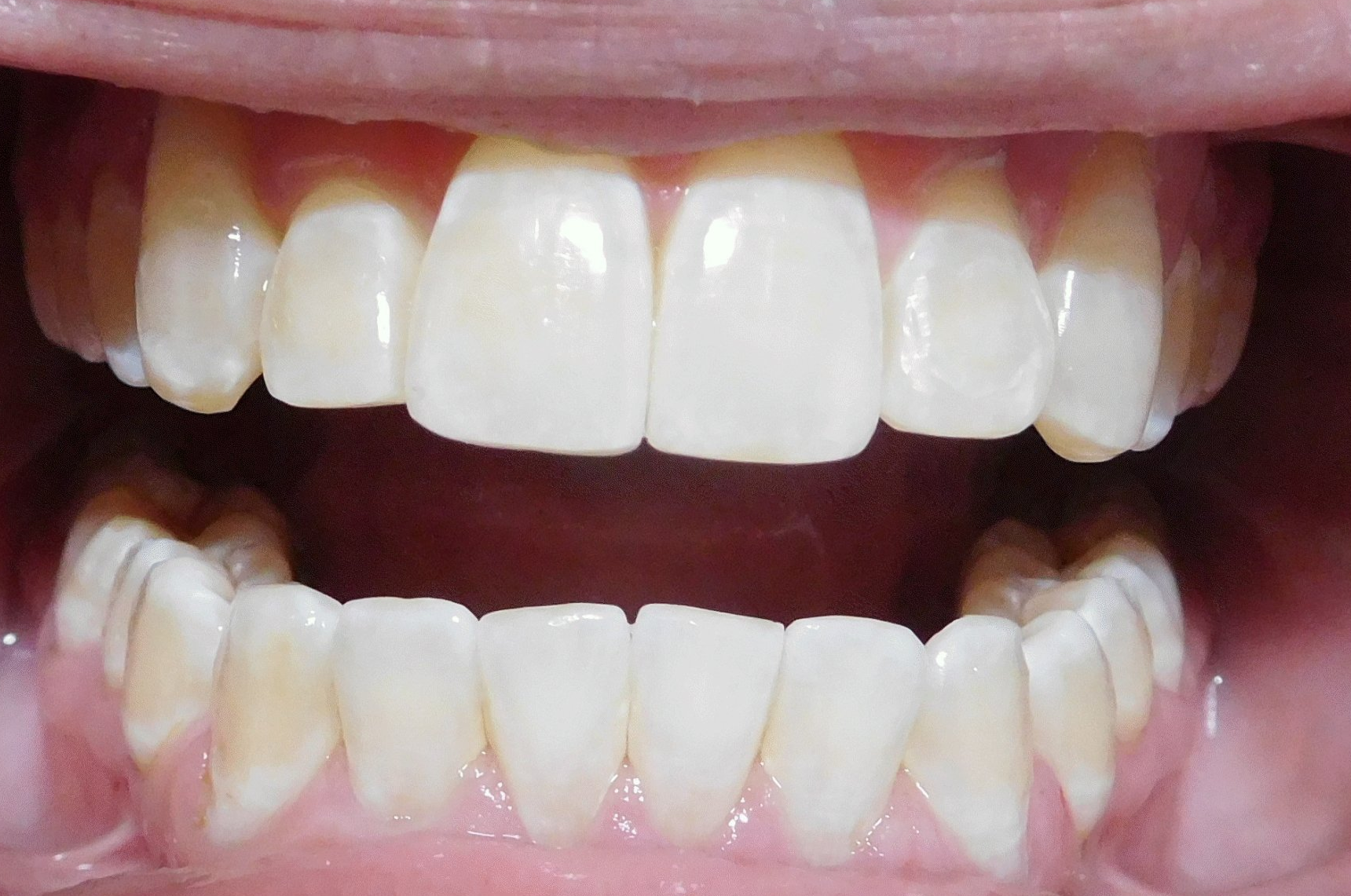 Porcelain Veneers