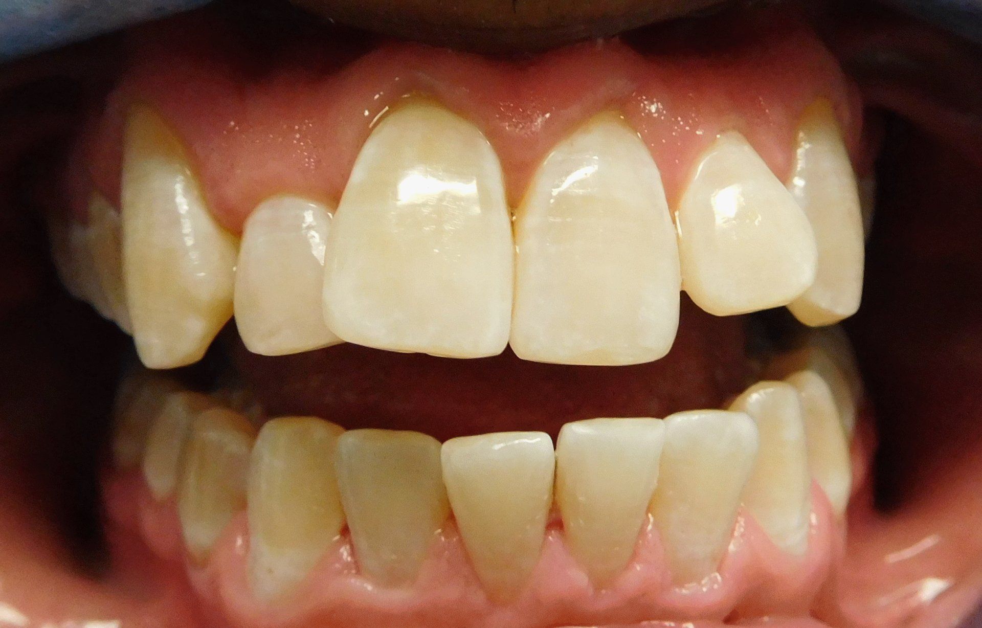 Porcelain Veneers