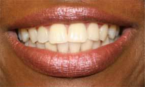 Porcelain Veneers